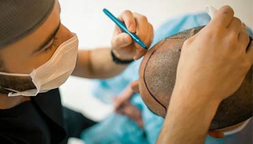 Hair Transplant at Adeel Medics