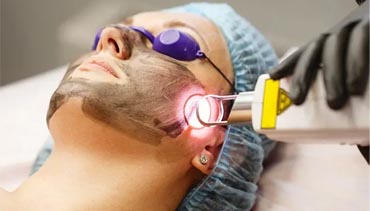 Laser Treatment at Adeel Medics